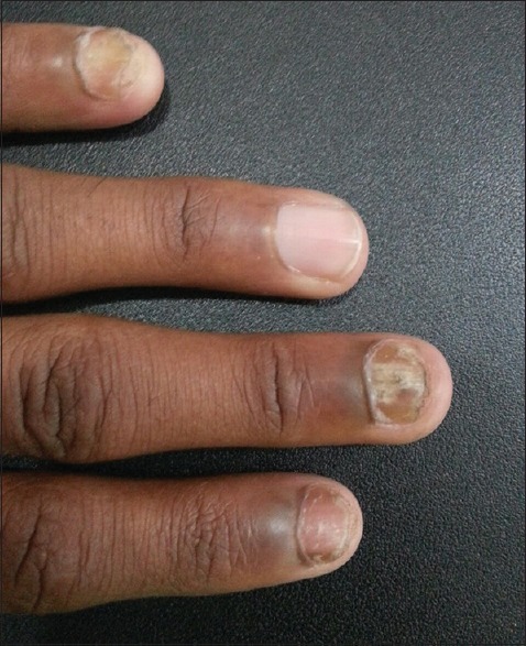 Study of prevalence of dermatophytes among human immunodeficiency virus/AIDS patients in Shadan Institute of Medical Sciences and Teaching Hospital and Research Centre, Hyderabad, Telangana, India.